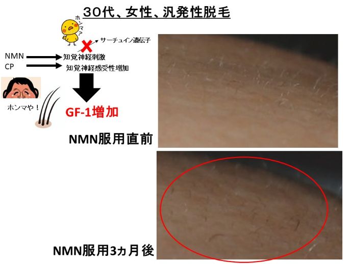 円形脱毛症　病院